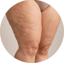 Ilustração de lipedema